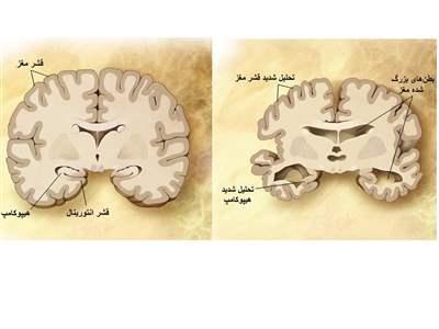تفاوت آلزایمر با زوال عقل چیست؟ 