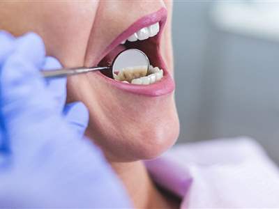 این نوع دندان درد می‌تواند نشانه سرطان باشد 