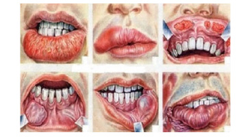 علائم خطرناکی در دهان که از ابتلا به سرطان خبر می‌دهند