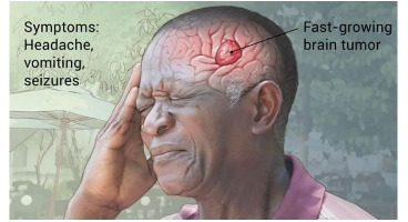  کدام نوع سردرد خبر از تومور مغزی می دهد؟