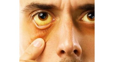   5 اختلال در چشم که نشان دهنده بیماری هستند