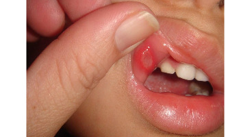  این نشانه ها در دهان یعنی این دو بیماری خطرناک را دارید
